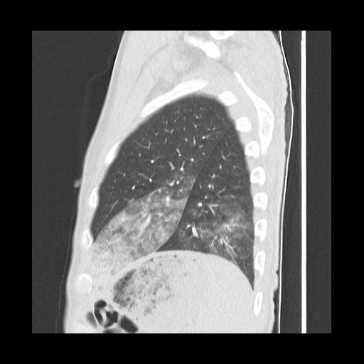 Accessory left horizontal fissure with lingular pneumonia (Radiopaedia 53763-59843 Sagittal lung window 56).jpg