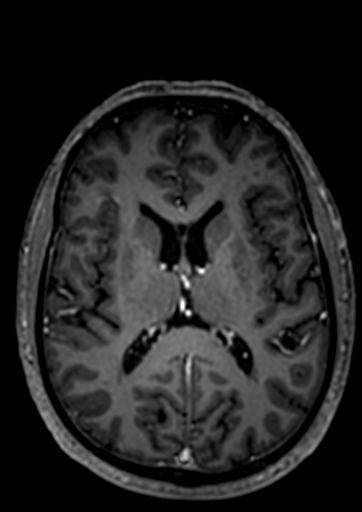 Accessory middle cerebral artery (Radiopaedia 73114-83828 Axial T1 C+ 12).jpg