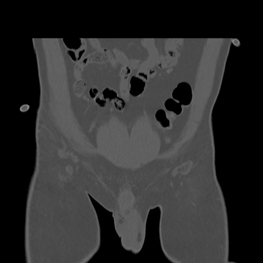 Acetabular and ilial fractures (Radiopaedia 59084-66378 Coronal bone window 4).jpg