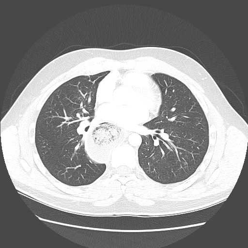 Achalasia (Radiopaedia 52507-58417 Axial lung window 34).jpg