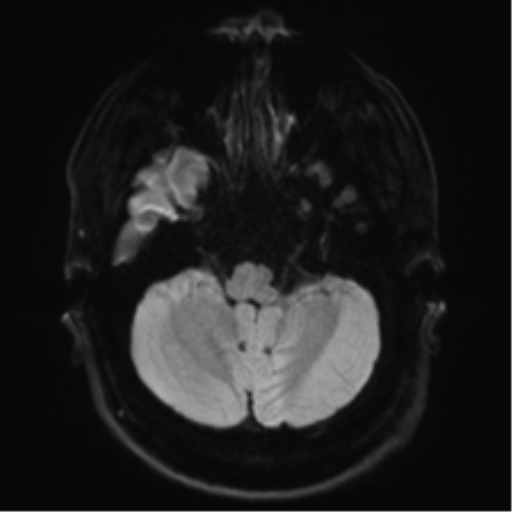 File:Achondroplasia (Radiopaedia 65109-74105 Axial DWI 4).png