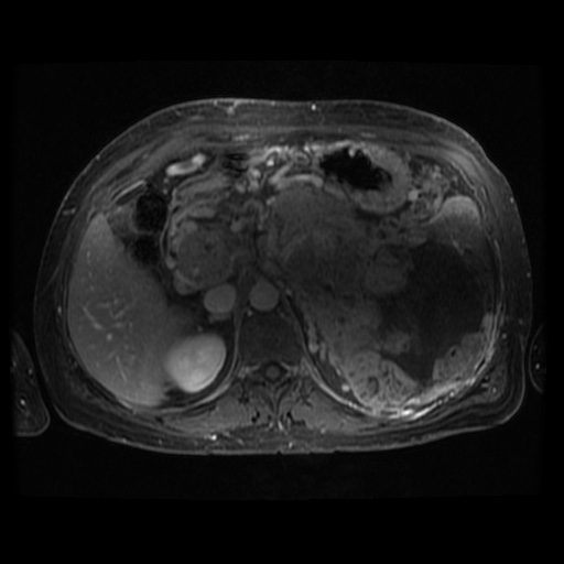 File:Acinar cell carcinoma of the pancreas (Radiopaedia 75442-86668 Axial T1 C+ fat sat 72).jpg