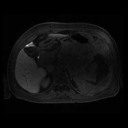 Acinar cell carcinoma of the pancreas (Radiopaedia 75442-86668 Axial late phase (~30 mins) 75).jpg