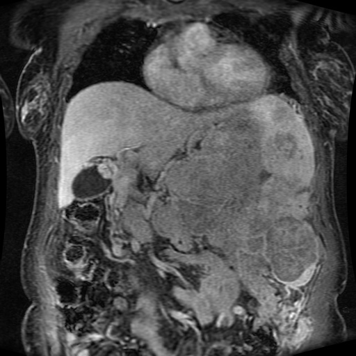 Acinar cell carcinoma of the pancreas (Radiopaedia 75442-86668 Coronal T1 C+ fat sat 125).jpg