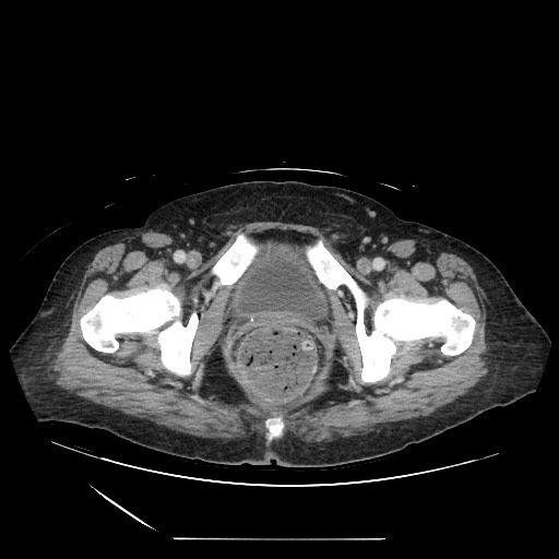 Acinar cell carcinoma of the pancreas (Radiopaedia 75442-86669 Axial C+ portal venous phase 144).jpg