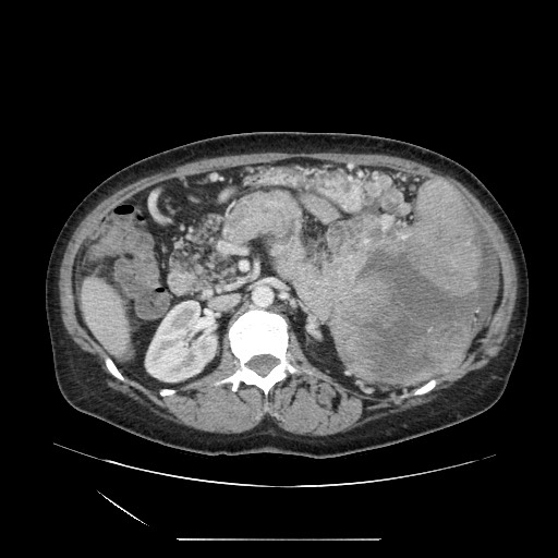 Acinar cell carcinoma of the pancreas (Radiopaedia 75442-86669 Axial C+ portal venous phase 57).jpg