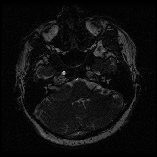 File:Acoustic schwannoma (Radiopaedia 33045-34060 Axial T2 22).png