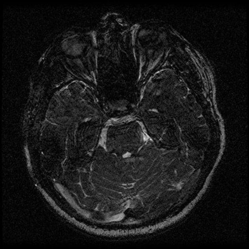Acoustic schwannoma (Radiopaedia 33045-34060 Axial T2 61).png