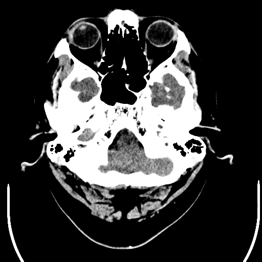 File:Acoustic schwannoma (Radiopaedia 39170-41389 Axial non-contrast 3).png