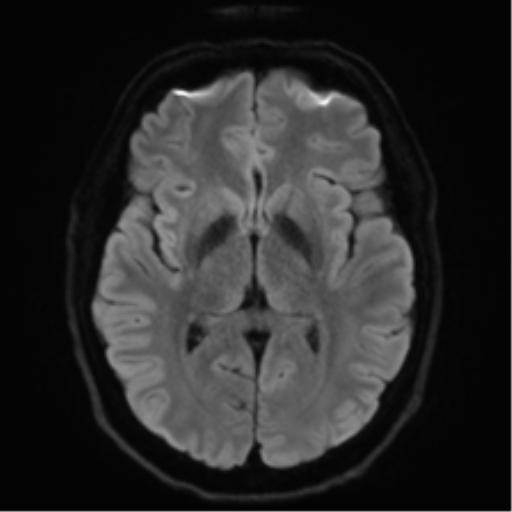 Acoustic schwannoma (Radiopaedia 50846-56358 Axial DWI 42).png