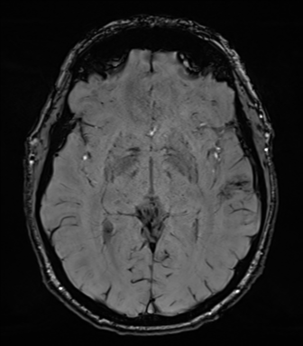 Acoustic schwannoma (Radiopaedia 50846-56358 Axial SWI 45).png