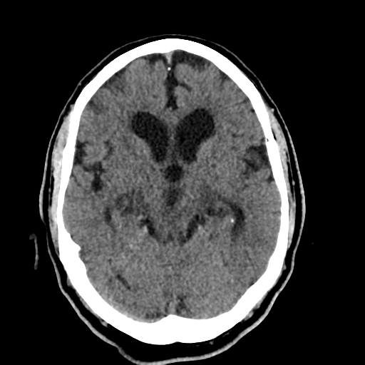 File:Acoustic schwannoma (Radiopaedia 55729-62280 Axial non-contrast 15).png