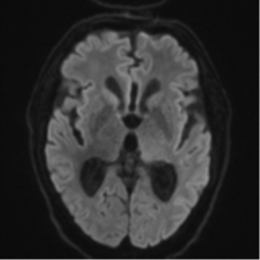 File:Acoustic schwannoma (Radiopaedia 55729-62281 E 40).png