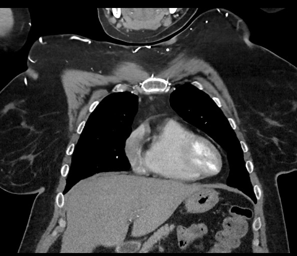 Acromioclavicular joint cyst (Radiopaedia 58455-65610 Coronal C+ arterial phase 49).jpg