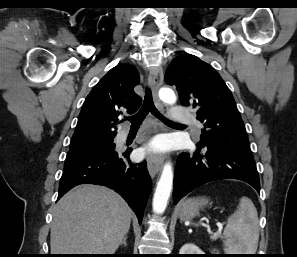 Acromioclavicular joint cyst (Radiopaedia 58455-65610 Coronal C+ arterial phase 89).jpg