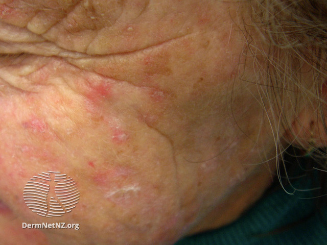 Actinic Keratoses affecting the face (DermNet NZ lesions-ak-face-474).jpg