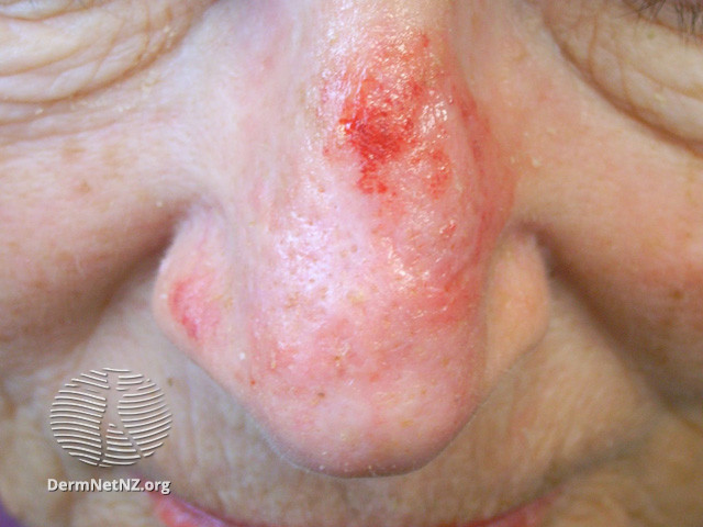 File:Actinic Keratoses treated with imiquimod (DermNet NZ lesions-ak-imiquimod-3725).jpg