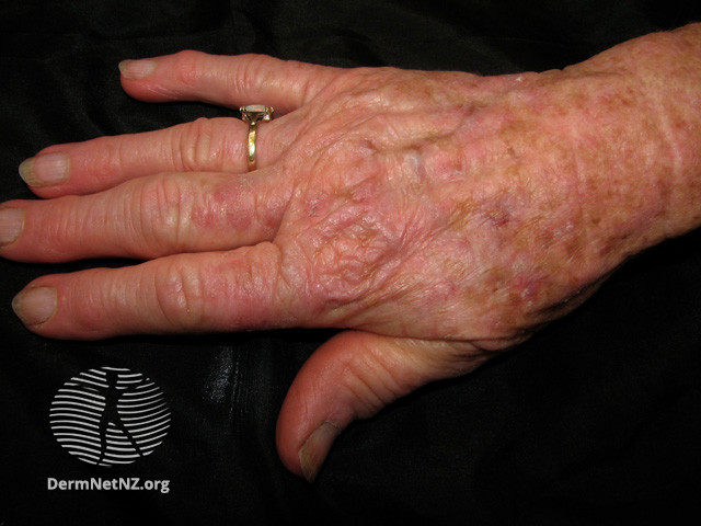 File:Actinic keratoses affecting the hands (DermNet NZ lesions-ak-hands-246).jpg