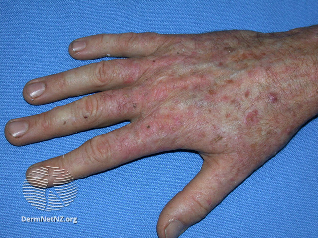File:Actinic keratoses affecting the hands (DermNet NZ lesions-ak-hands-412).jpg
