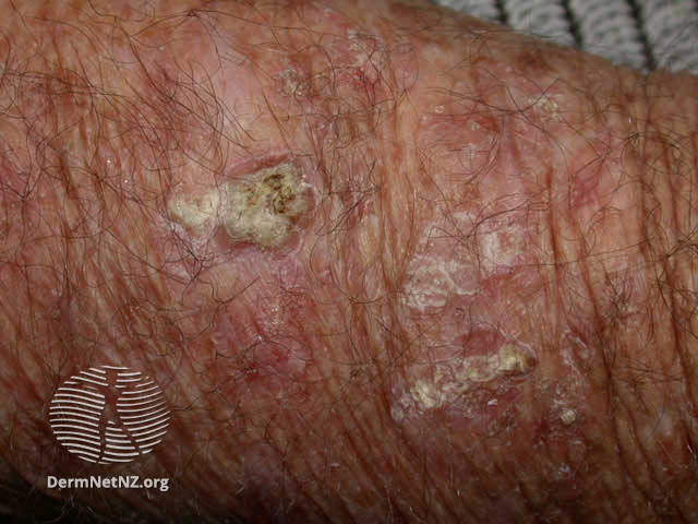 File:Actinic keratosis (DermNet NZ doctors-lesions-images-sk3).jpg