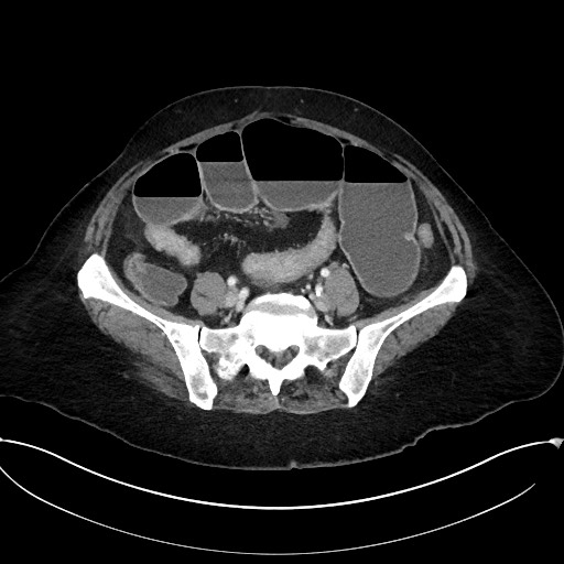 Active Crohn disease (Radiopaedia 59394-66750 Axial C+ portal venous phase 51).jpg