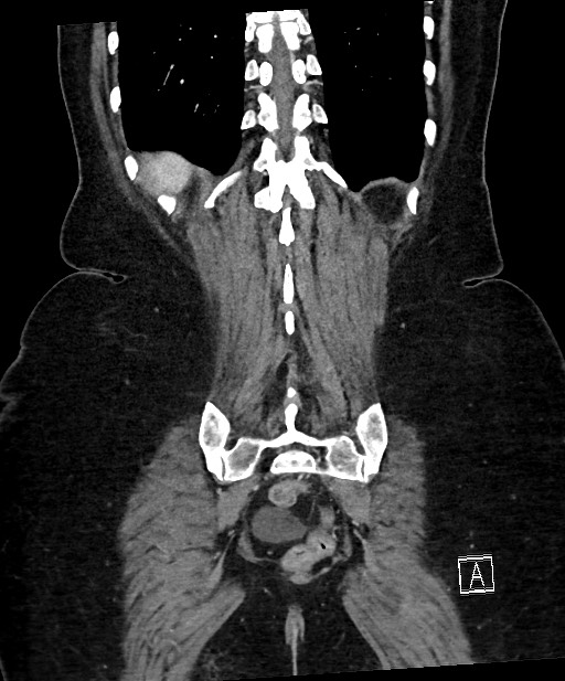 Active Crohn disease (Radiopaedia 59394-66750 Coronal C+ portal venous phase 58).jpg