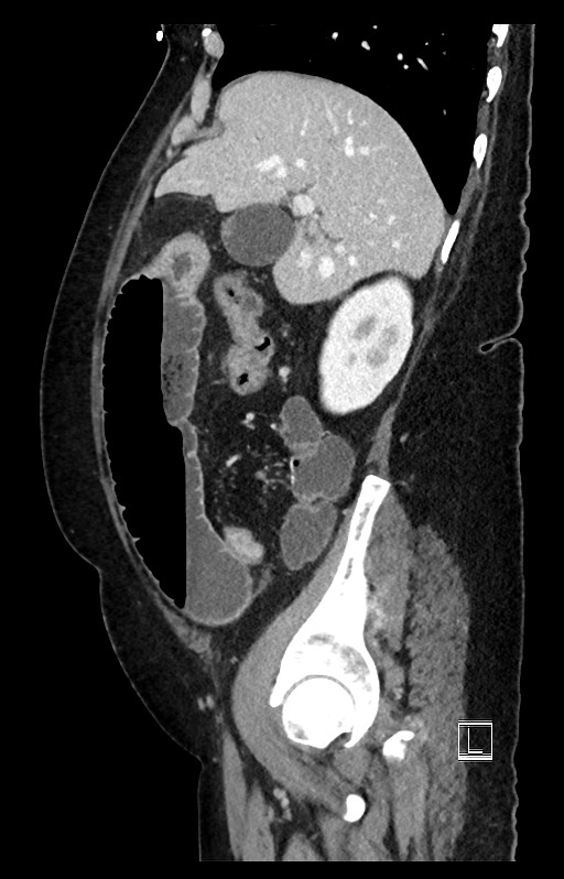 Active Crohn disease (Radiopaedia 59394-66750 Sagittal C+ portal venous phase 42).jpg