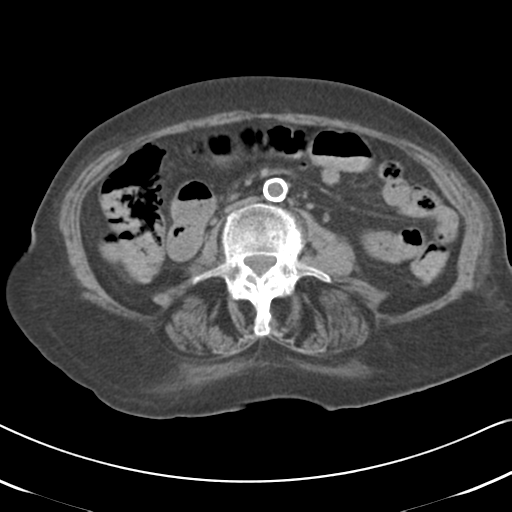 File:Active bleeding from duodenal ulcer with embolization (Radiopaedia 34216-35481 Axial non-contrast 33).png