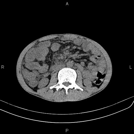 Active crohn disease (Radiopaedia 87133-103397 Axial non-contrast 50).jpg