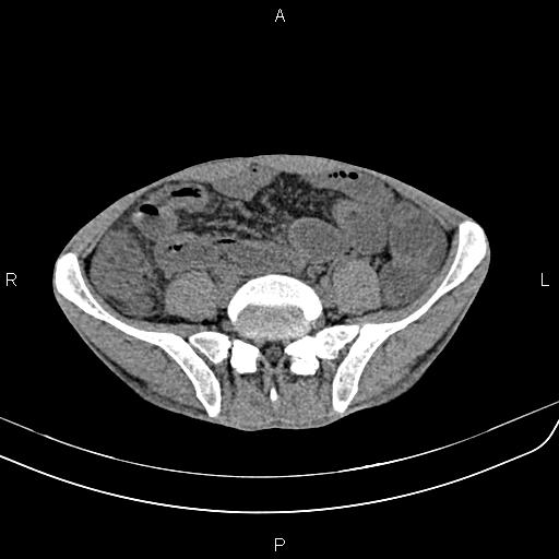 File:Active crohn disease (Radiopaedia 87133-103397 Axial non-contrast 71).jpg