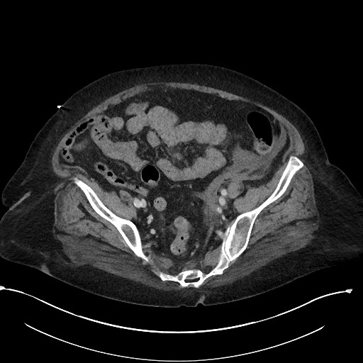 File:Active renal extravasation with large subcapsular and retroperitoneal hemorrhage (Radiopaedia 60975-68796 Axial 276).jpg