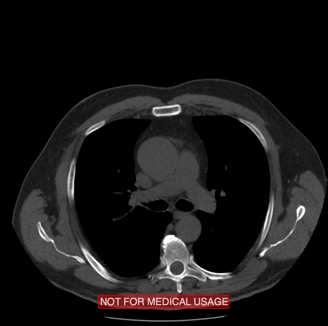Acute aortic dissection - Stanford type A (Radiopaedia 40661-43285 Axial non-contrast 19).jpg