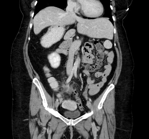 Acute appendicitis, heterotaxy syndrome (Radiopaedia 66884-76202 Coronal C+ portal venous phase 57).jpg