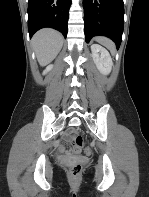 Acute appendicitis (Radiopaedia 62608-70901 Coronal C+ portal venous phase 43).jpg