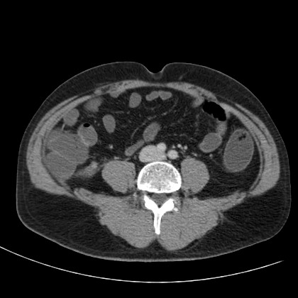 Acute appendicitis (Radiopaedia 66513-75790 Axial C+ portal venous phase 52).jpg