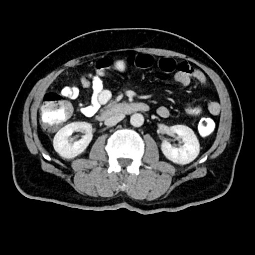 Acute appendicitis (Radiopaedia 77016-88960 Axial C+ portal venous phase 66).jpg