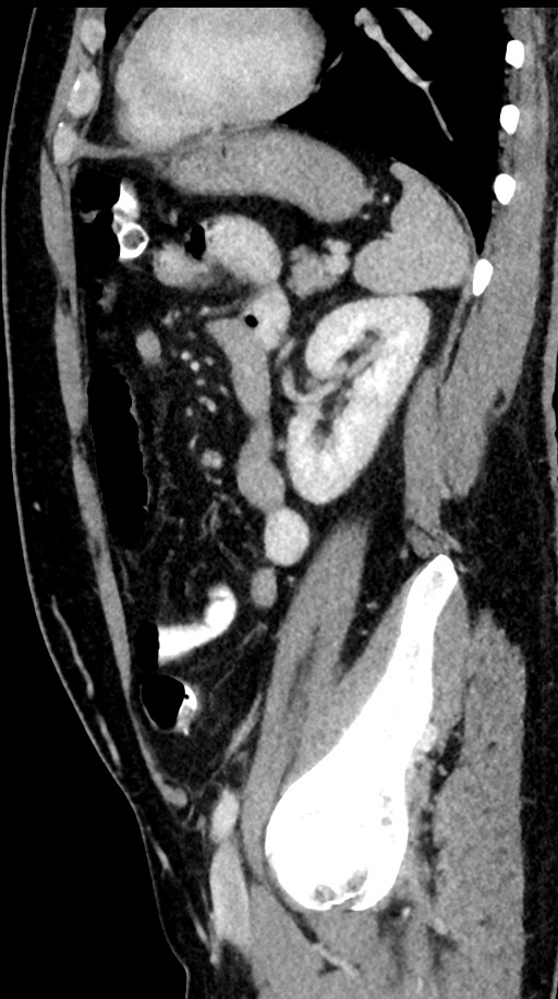 Acute appendicitis (Radiopaedia 77016-88960 Sagittal C+ portal venous phase 36).jpg
