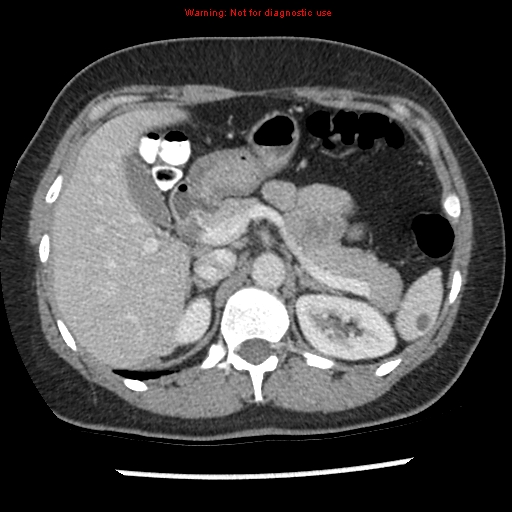 File:Acute appendicitis (Radiopaedia 7966-8812 C+ portal venous phase 8).jpg