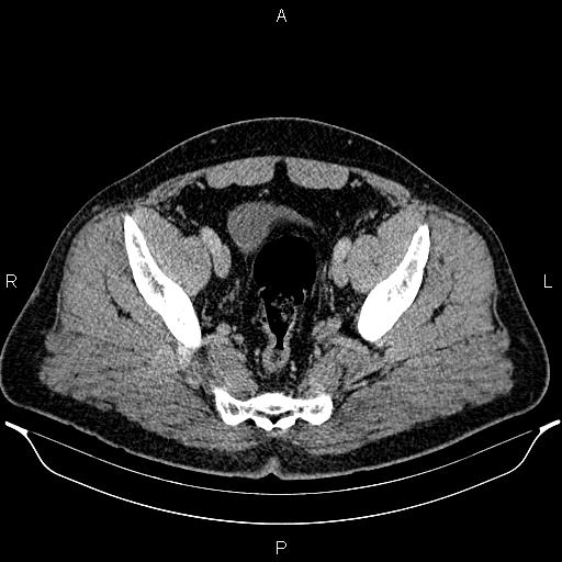 Acute appendicitis (Radiopaedia 84780-100240 Axial C+ portal venous phase 93).jpg