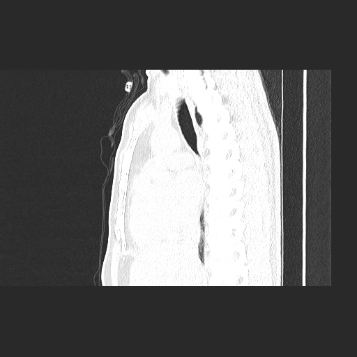 Acute appendicitis and COVID 19 pneumonia (Radiopaedia 76604-88380 Sagittal lung window 46).jpg