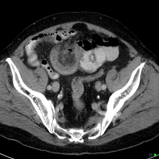 File:Acute appendicitis arising from a malrotated cecum (Radiopaedia 19970-19997 Axial C+ portal venous phase 38).jpg