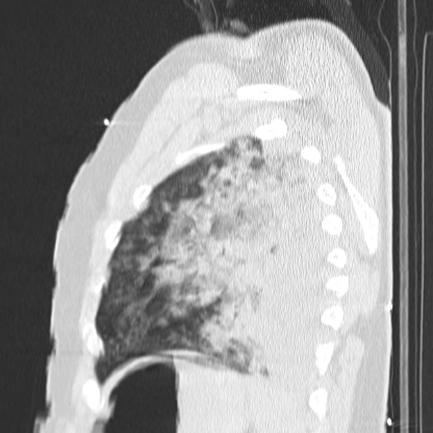 Acute aspiration pneumonitis (Radiopaedia 33605-34703 Sagittal lung window 70).jpg
