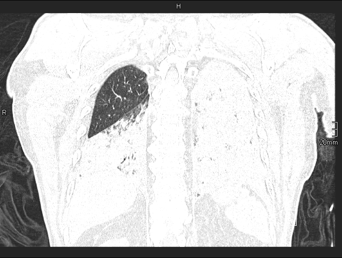 Acute aspiration pneumonitis (Radiopaedia 55642-62166 Coronal lung window 82).jpg