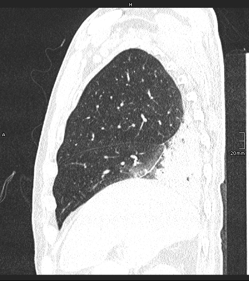 Acute aspiration pneumonitis (Radiopaedia 55642-62166 Sagittal lung window 118).jpg