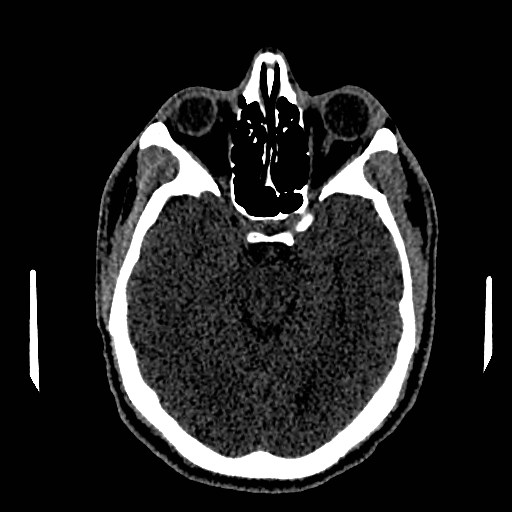 File:Acute basilar artery occlusion (Radiopaedia 43582-46985 Axial non-contrast 76).jpg