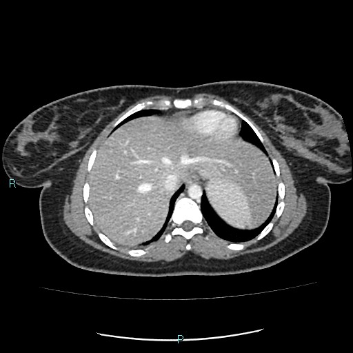 Acute bilateral pyelonephritis (Radiopaedia 37146-38881 Axial C+ portal venous phase 8).jpg