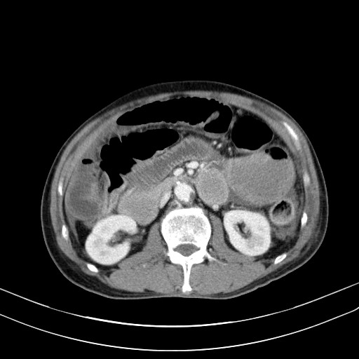Acute bowel ischemia (Radiopaedia 87695-104114 Axial C+ portal venous phase 37).jpg