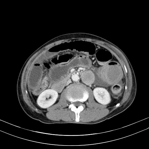 Acute bowel ischemia (Radiopaedia 87695-104114 Axial C+ portal venous phase 39).jpg