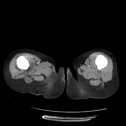 Acute calculous cholecystitis in patient with osteopetrosis (Radiopaedia 77871-90159 Axial C+ portal venous phase 89).jpg