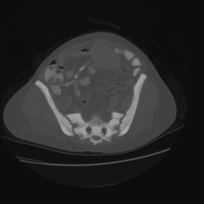 File:Acute calculous cholecystitis in patient with osteopetrosis (Radiopaedia 77871-90159 Axial bone window 39).jpg